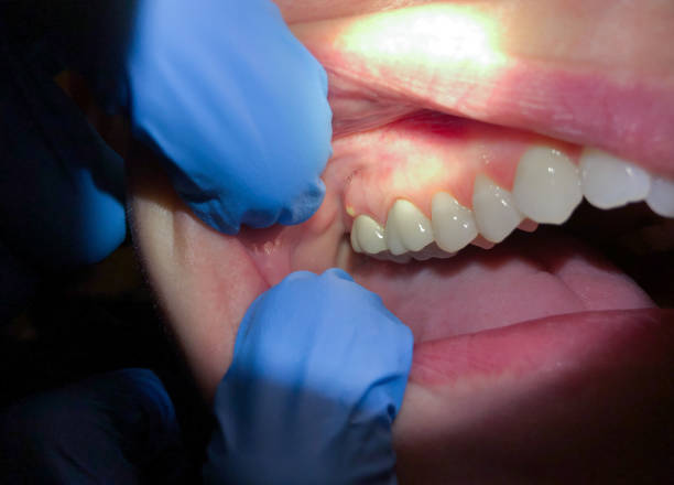 Best Tooth Infection Emergency Dentist  in Abbeville, AL